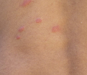 do flea bites look like pimples on dogs